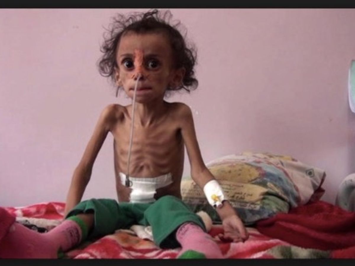 yemen child hungry