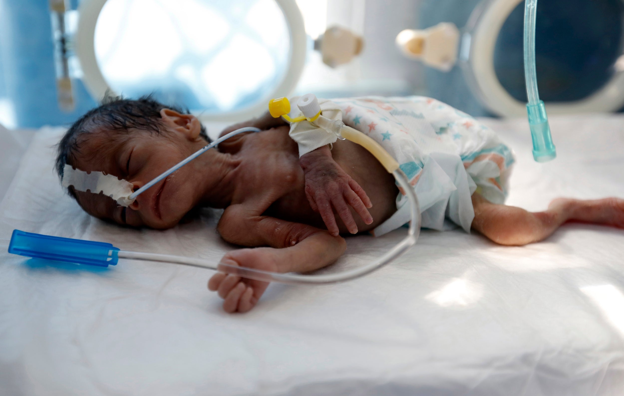 yemen child hungry